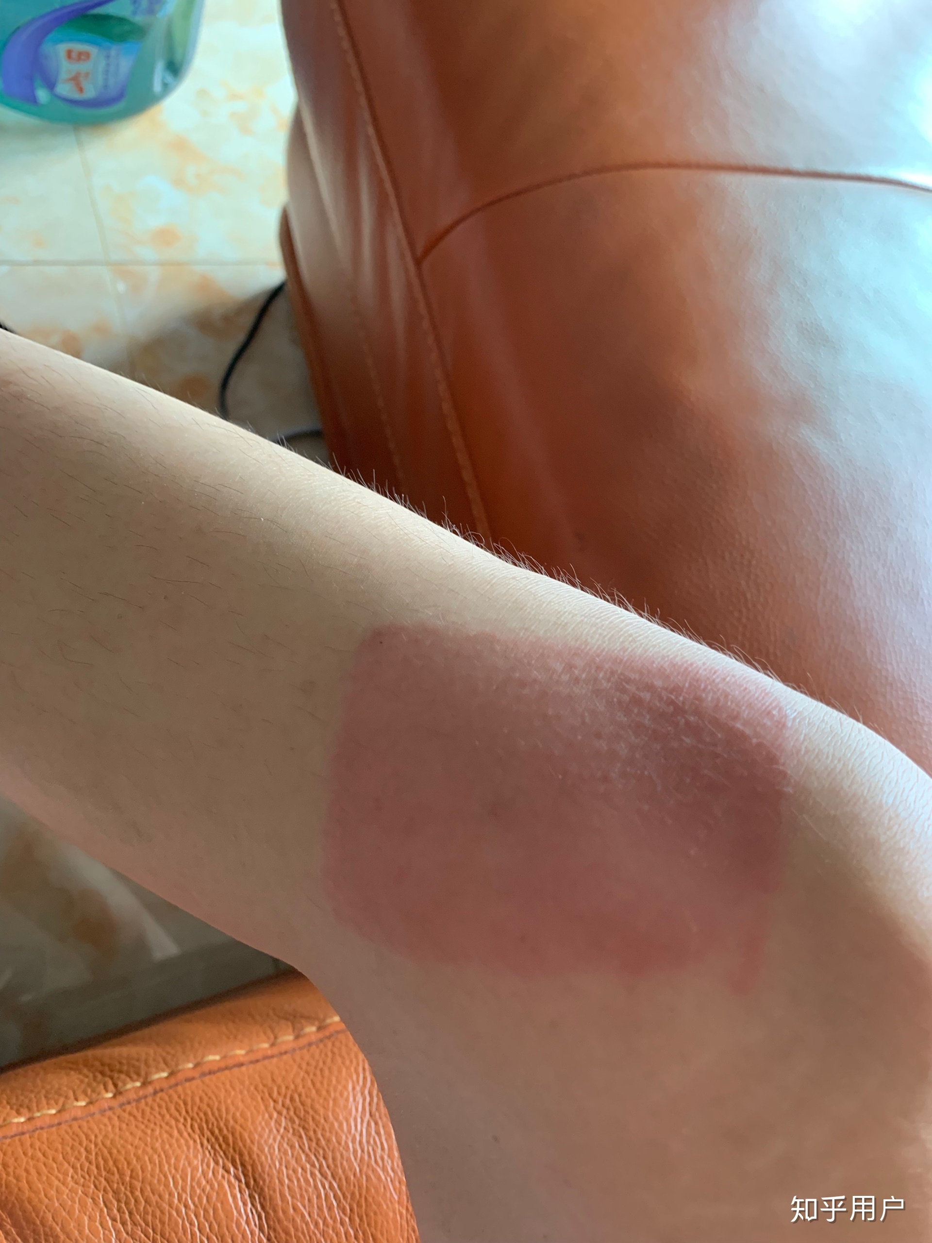 2、貼膏藥的地方有很多紅疙瘩，好不好？